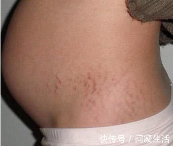妈妈们|肚子长毛、有黑线？怀孕后肚子的这几点变化最明显
