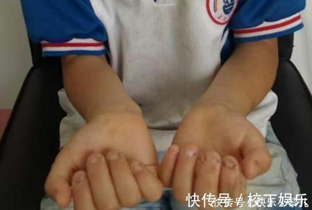 小动作|从小“咬指甲”的孩子,长大后会变成啥样专家逃不过2种结局