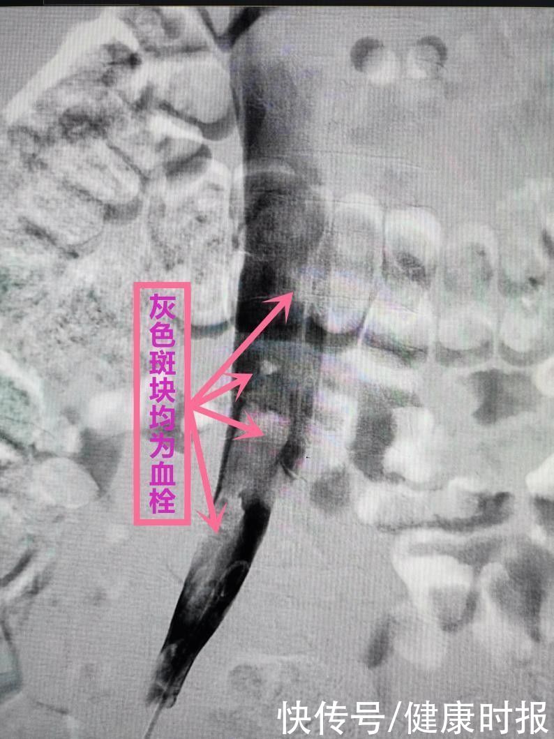 介入治疗|90后小伙玩电脑久坐不起？专家：血栓塞满下肢静脉差点致瘫