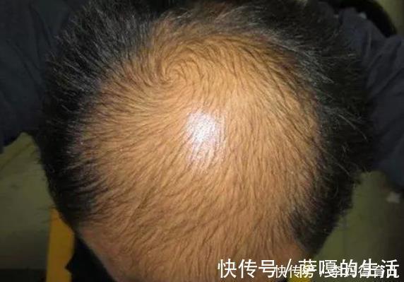 脾胃|中医坦露:脾虚身体有4个毛病!牢记3个妙方,让脾胃强健起来!