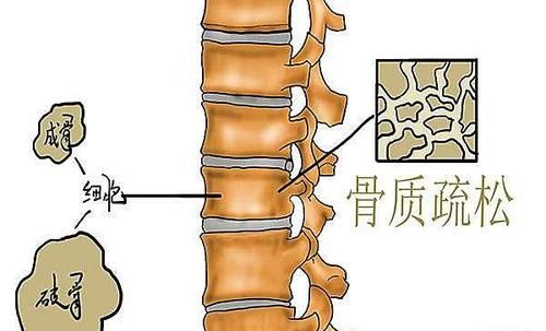 50歲后,骨質容易流失,如何補鈣,預防骨折?醫生逐條告訴您