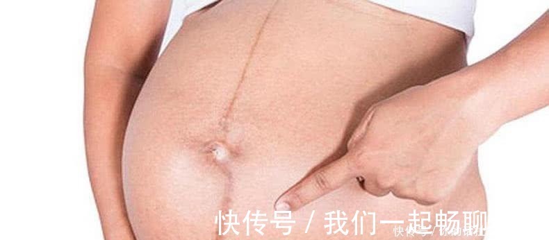 白线|原来孕妈肚子上的“黑线”,透露这些秘密!