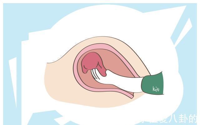 手剥胎盘|手剥胎盘?听着都疼,可为啥还有产妇感觉不那么痛?