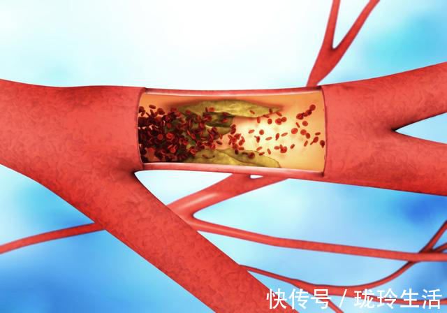 清道夫|血管“清道夫”被找到了,每天吃一点,血管不堵不硬,远离血栓!