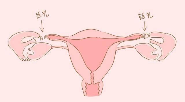 结扎|产后,女性是结扎好还是上环好看看过来人的遭遇,你就明白了
