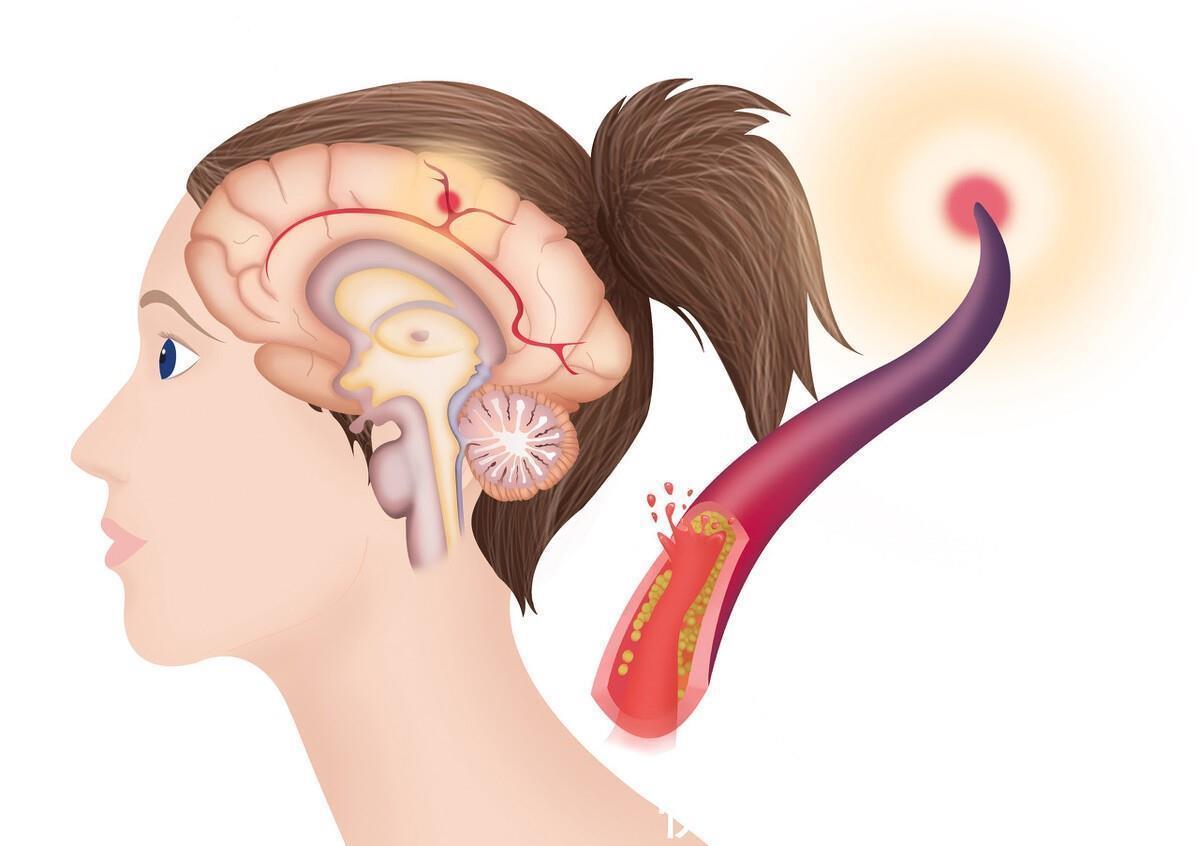 腔梗|腔隙性脑梗塞要不要吃药?需要看病因,避免过度治疗