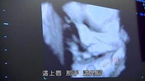 子宫|剖腹产没半年又怀孕,孕30周后子宫破裂,大人保住了孩子却没了