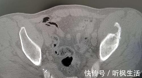 肺癌|肺癌最早爱往哪些部位转移?转移了还有救吗?