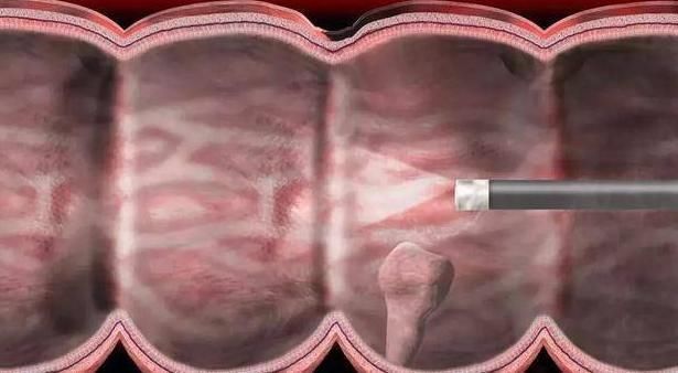 老戴|有三种息肉最好及时切除,拖延太久就会变成恶性肿瘤!你清楚吗?