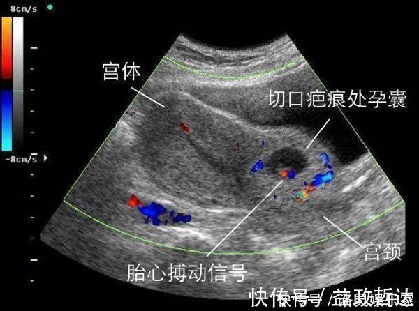 预产期|剖腹产没半年又怀孕，孕30周后子宫破裂，大人保住了孩子却没了