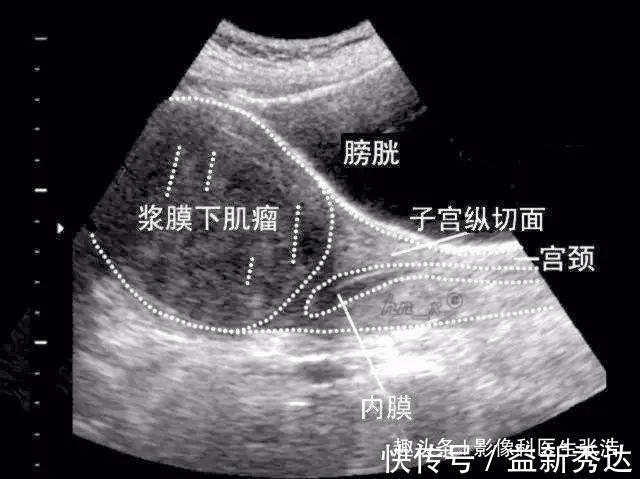 预防|子宫肌瘤能不能预防，生活中以下5点需要注意到