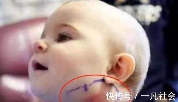 宝宝|2岁宝宝脸上长出“羽毛”,宝妈觉得很可爱,检查后医生:太无知