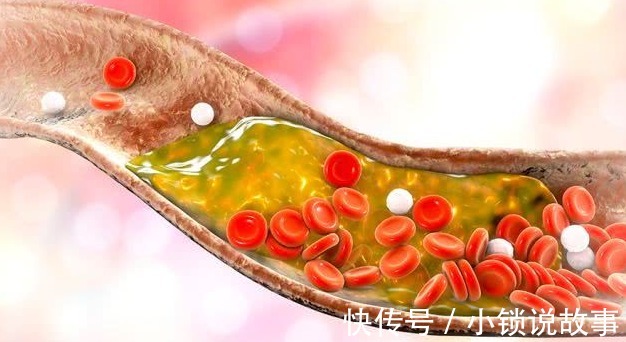 血管堵塞|高血脂的“源头”已发现,专家呼吁停止食用“2物”,远离脑梗