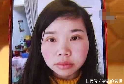 工地|女子在工地上班,割完双眼皮朋友说吓人,医院:个人喜好不同