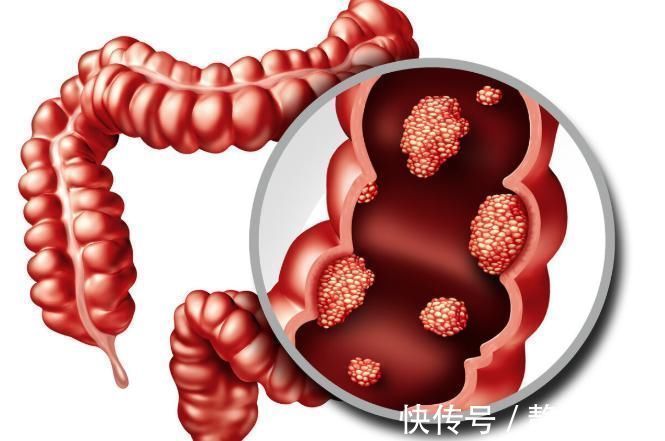 便血|直腸癌中晚期分別有哪些癥狀醫生的答案來了