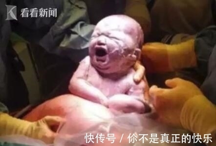 柔伊|医生从妈妈肚子里取出一个肉球！网友：这是哪吒啊