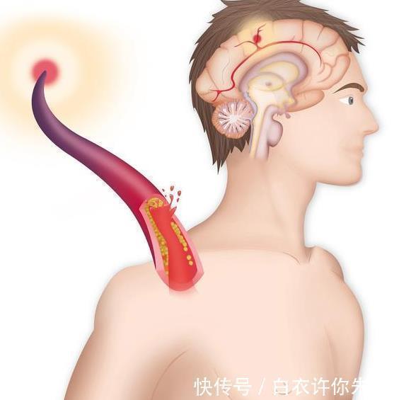 医生4类人群易发颈动脉问题,不及时治疗可能引起脑中风