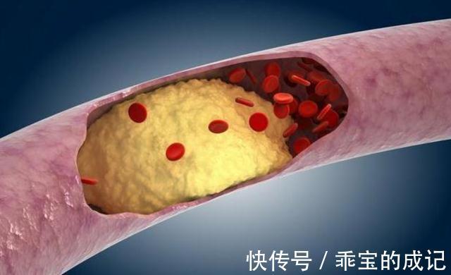 调味品|高血脂患者不能吃大蒜吗？提醒：想要降血脂，建议多吃3种食物