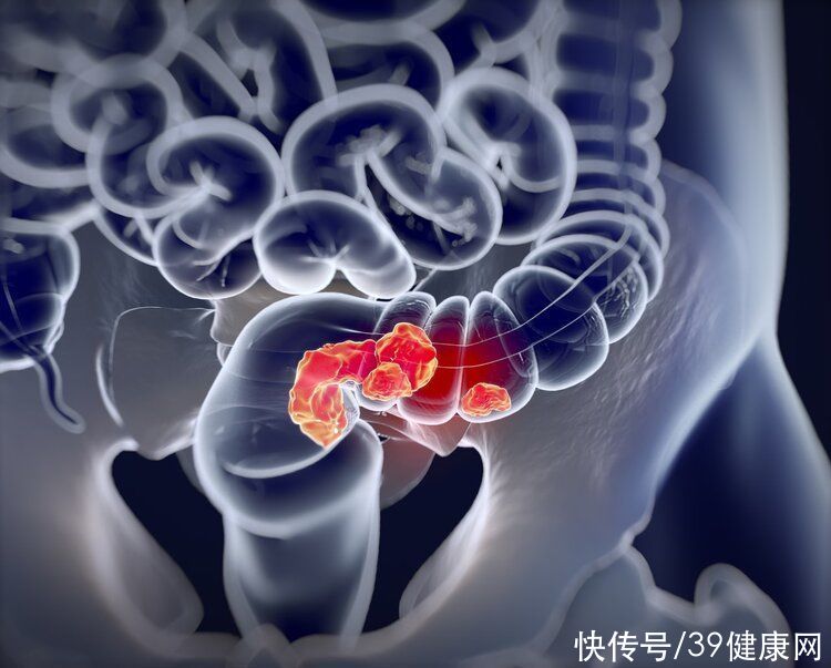 肠癌|中国每2分钟就有1人死于肠癌,出现3种表现,肠道已“病”得不轻