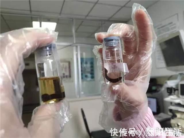 生水|女子喉咙中取出5厘米长的蚂蟥,这个习惯很多人都有