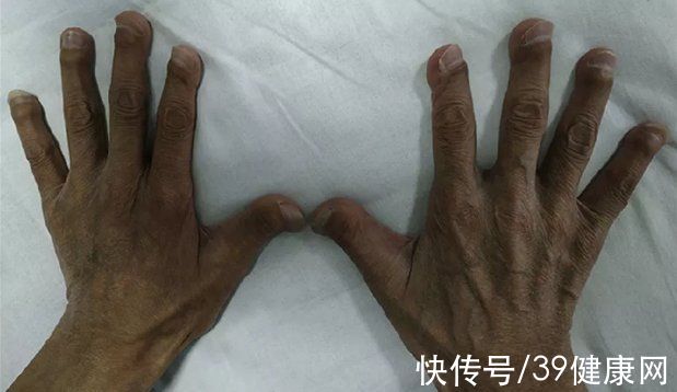 尿毒症|透析22年，49岁男子全身多处骨骼“溶解”，身高只剩一米五