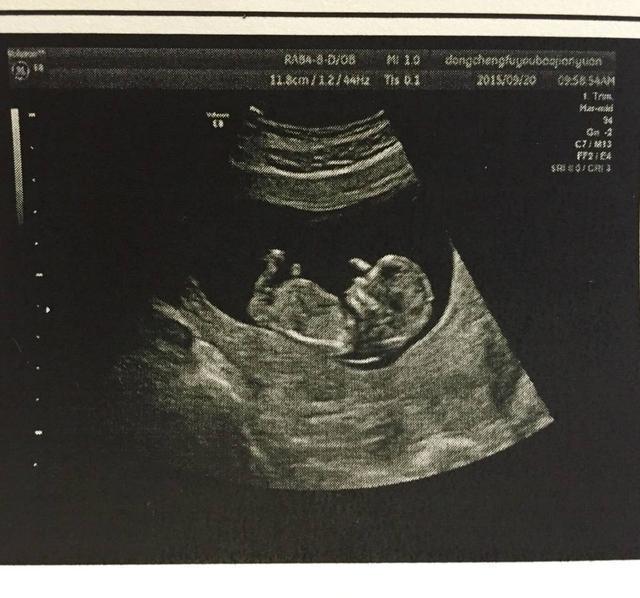 医生|两年备孕怀上双胞胎，B超结果是连体婴儿，坚持下来后意外惊喜！