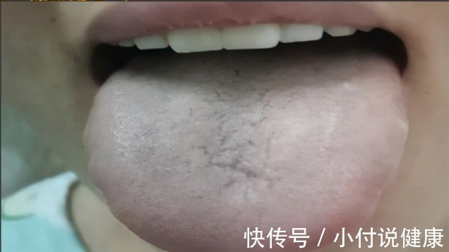 体质|两个位置测血瘀，一个中成药化淤血，4种血瘀体质了解一下