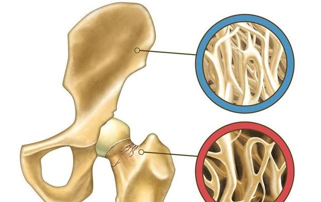  老年人|骨质疏松怎么办？先做到这3点，把骨头慢慢“养”好！老年人记牢
