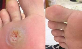 自然|鸡眼脚疼痛难受教你小秘方,轻松让鸡眼自然脱落,不留痕迹