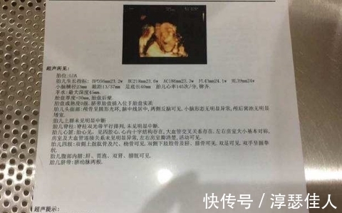 胎儿|B超中若显示这些特点,或许在暗示是一个小公主!