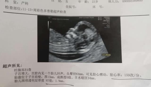 透明层|孕期这项检查,能率先查出畸形儿,产妇却崩溃比高考还难通过