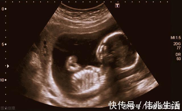 ·兰德|妻子怀孕20周,产检时被告知胎儿没有肺,夫妻俩依然决定留下这个孩子