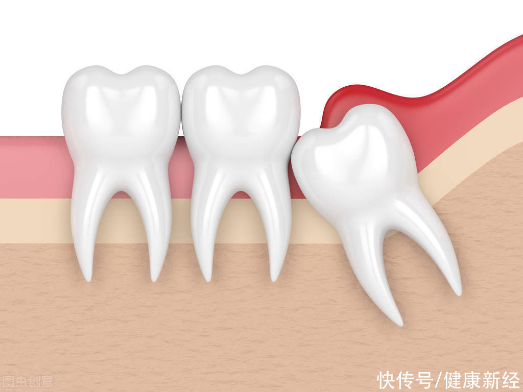 邻牙|智齿有什么危害？到底应不应该拔掉？