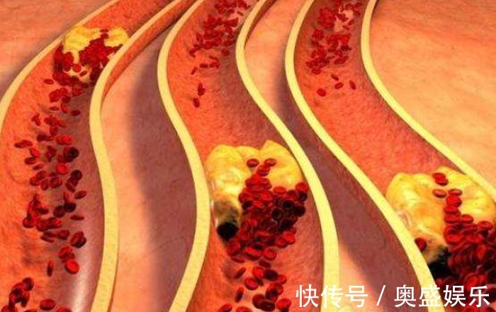 血脂|高血脂不能吃鸡蛋,尤其鸡蛋黄医生辟谣和鸡蛋没有半毛钱关系