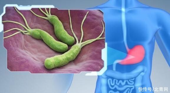 胃黏膜|幽门螺杆菌感染治还是不治?儿童符合这些情况者应根治