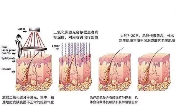  脂肪粒|眼部脂肪粒要怎么消解才好呀？