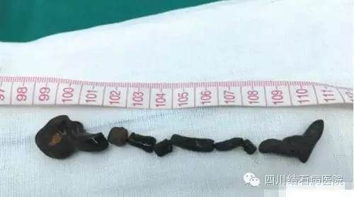 家长须知：做到这几点 让您的孩子远离胆结石