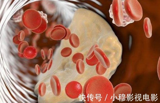 男子|38岁男子高血脂半年，血脂从9.7降至1.6，医生：方法值得效仿