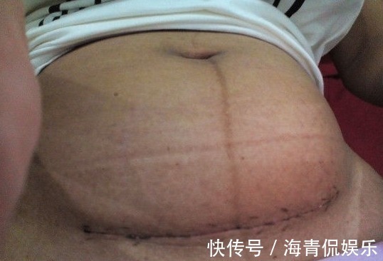 剖腹产|女子剖腹产三个月伤口冒水,医生检查伤口,不淡定