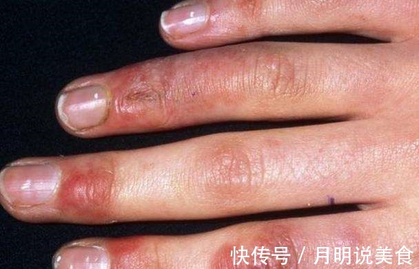 桂枝|天冷了,有冻疮怎么办一味中药,水煎,浸洗,很方便