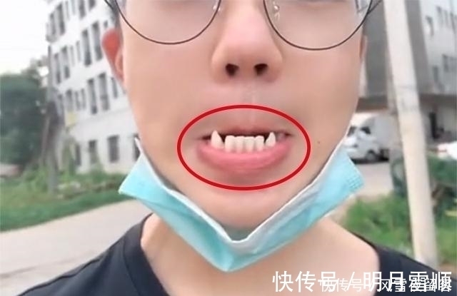 妈妈|17岁孩子长尖牙,妈妈以为是假的,亲手摸过后吐槽:像“吸血鬼”