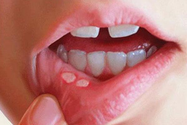 口腔溃疡|嘴上经常长泡，是怎么回事可能是这4种疾病的“信号”，别忽视