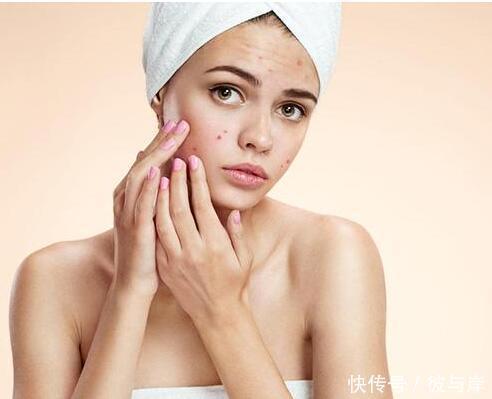 熬夜会不会留痘印?不想留痘印,这些坏习惯确实需要改一改!