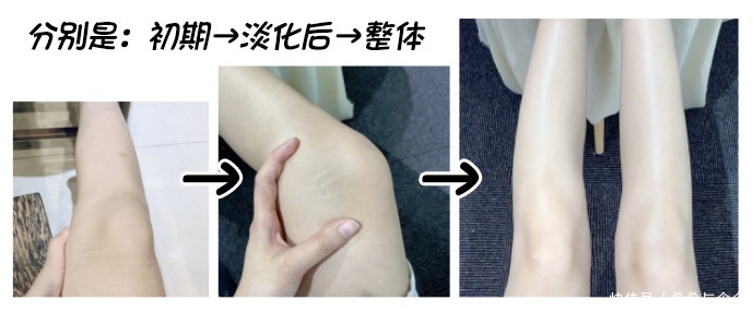 生长纹|光肚皮孕妈生长纹、妊娠纹修复两手抓!最佳淡化cp竟不是妊娠油!