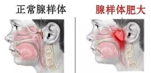 腺样体|聚焦夏季儿童高发耳鼻喉疾病