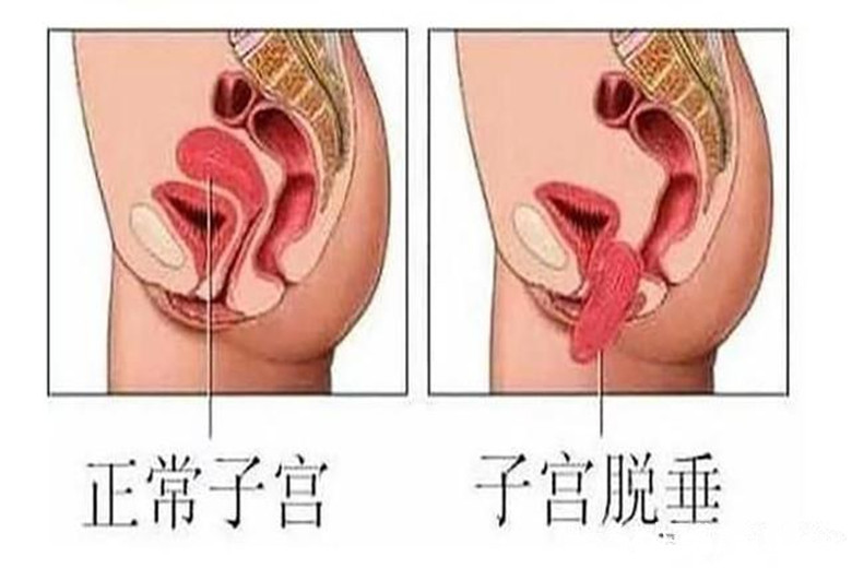 小豆|产妇生娃15天,上厕所流出“一块肉”,医生感叹无知害人