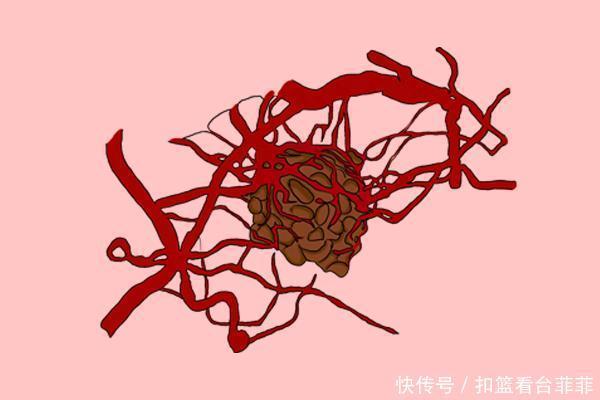  腺癌的风险|容易得癌的人，的确会有“共通点”，烟酒不算，望能敲响警钟