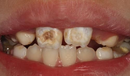 人家|让孩子“满嘴烂牙”的不是糖,而是“这1物”,每个人家里都有