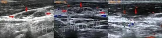 复发|20多岁小伙患甲状腺癌,2年复发3次!医生重要提醒