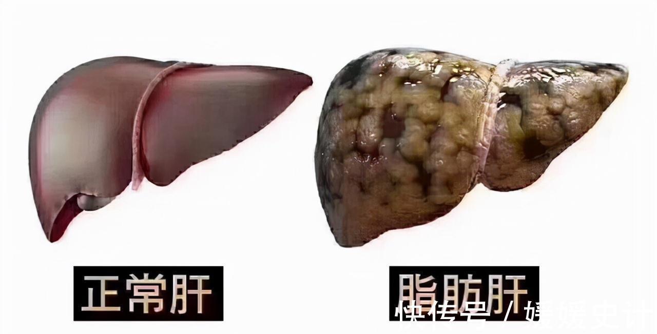 人体|肚子总是感觉饿，别以为只是消化快，五种疾病可能正在悄悄关注你